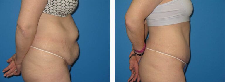 Abdominoplasty-Case-38-3
