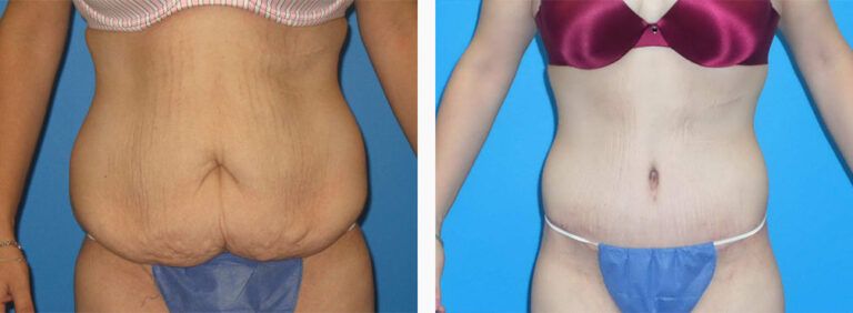 Abdominoplasty-Case-39-1