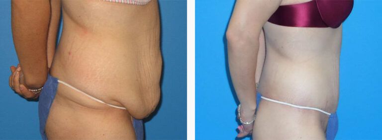 Abdominoplasty-Case-39-2
