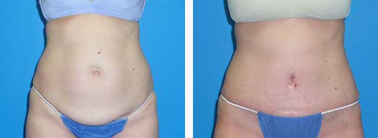 Abdominoplasty-Case-40-1