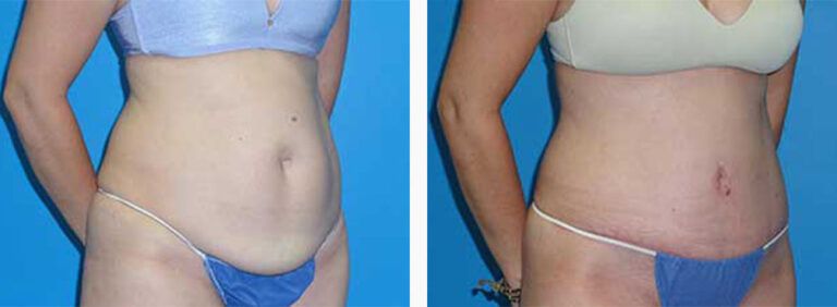 Abdominoplasty-Case-40-2