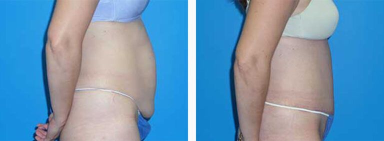 Abdominoplasty-Case-40-3