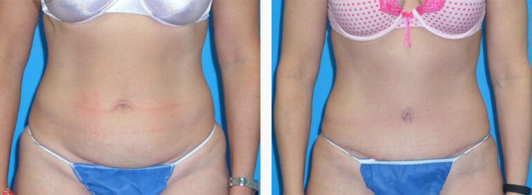 Abdominoplasty-Case-41-1