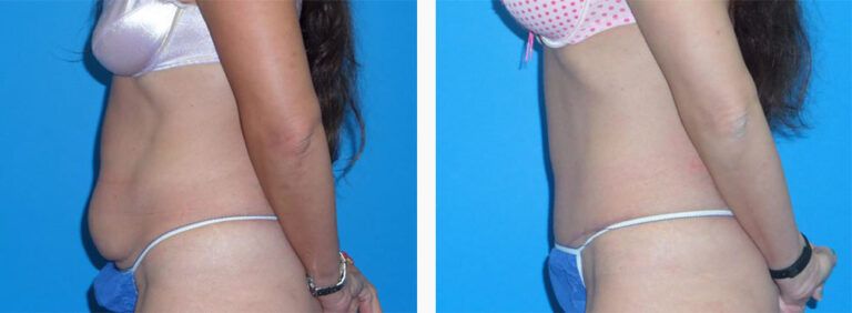 Abdominoplasty-Case-41-2