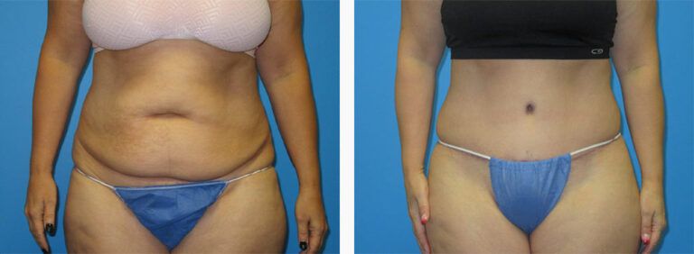 Abdominoplasty-Case-42-1