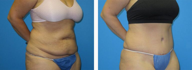 Abdominoplasty-Case-42-2
