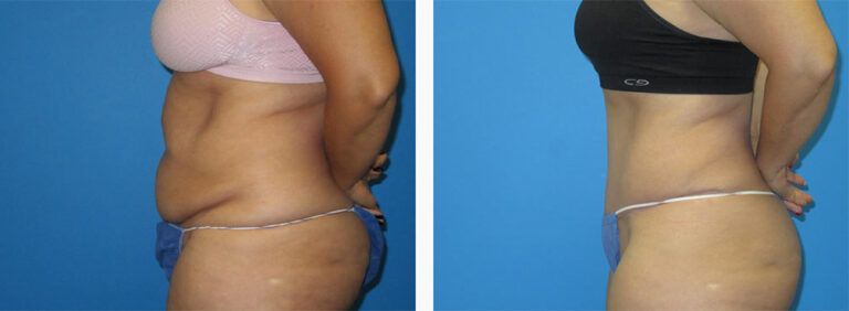 Abdominoplasty-Case-42-3