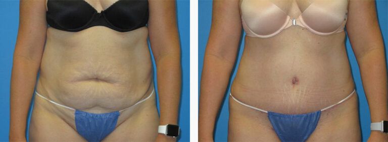 Abdominoplasty-Case-43-1