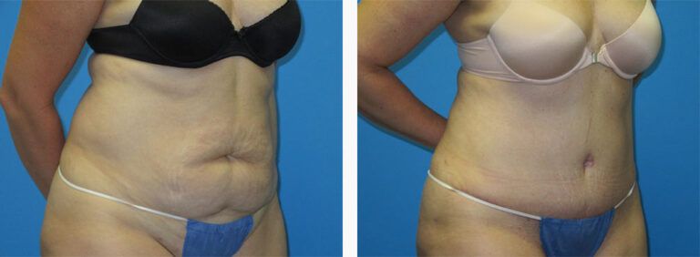 Abdominoplasty-Case-43-2