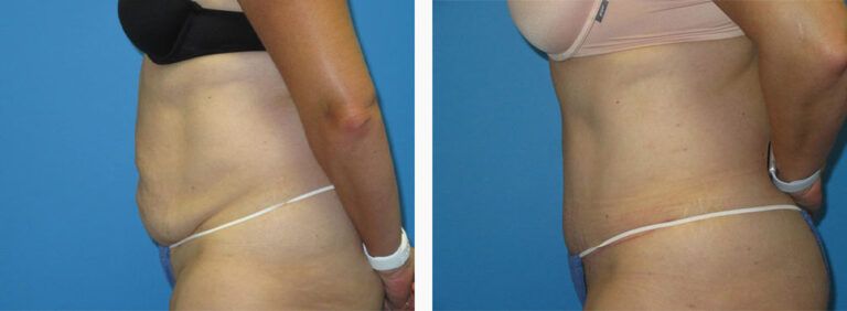 Abdominoplasty-Case-43-3