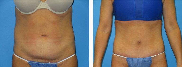 Abdominoplasty-Case-44-1