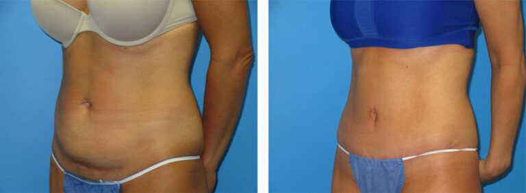 Abdominoplasty-Case-44-2