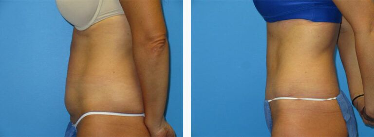 Abdominoplasty-Case-44-3