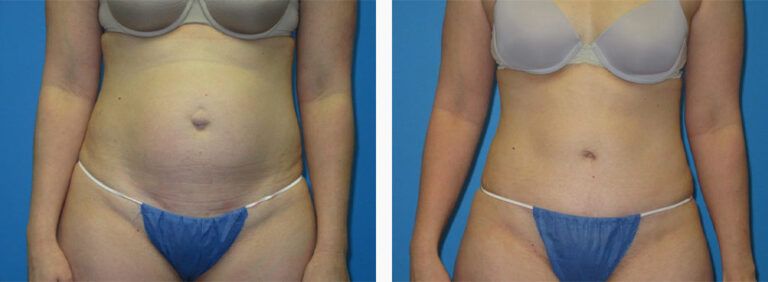 Abdominoplasty-Case-45-1