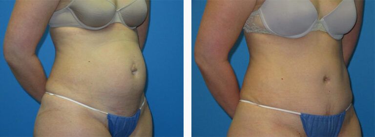 Abdominoplasty-Case-45-2