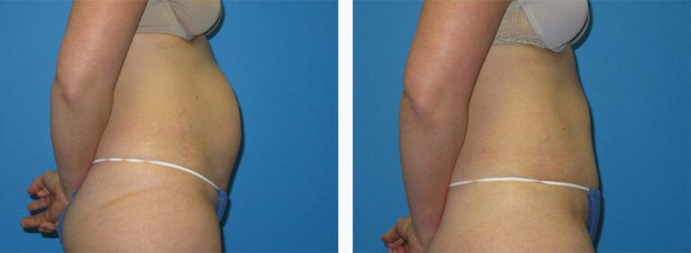 Abdominoplasty-Case-45-3