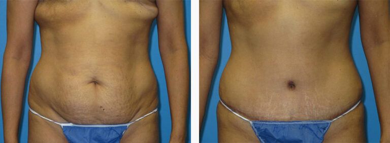 Abdominoplasty-Case-46-1