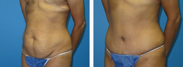 Abdominoplasty-Case-46-2
