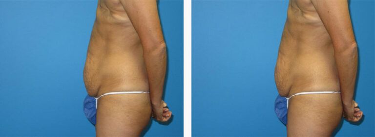 Abdominoplasty-Case-46-3