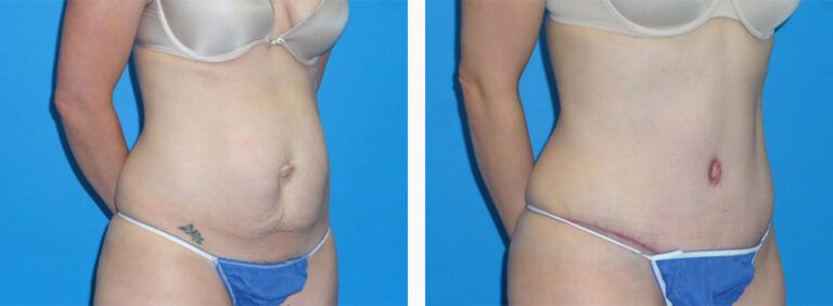 Abdominoplasty-Case-47-1