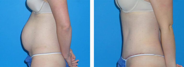 Abdominoplasty-Case-47-2