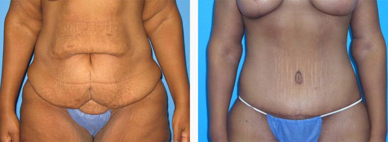 Abdominoplasty-Case-48-1