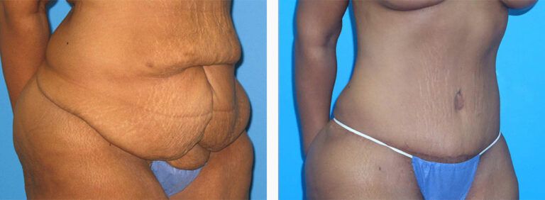 Abdominoplasty-Case-48-2