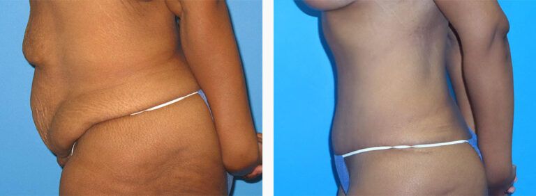 Abdominoplasty-Case-48-3