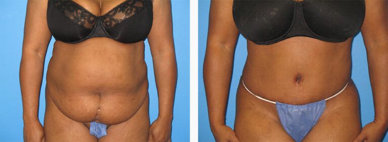 Abdominoplasty-Case-49-1