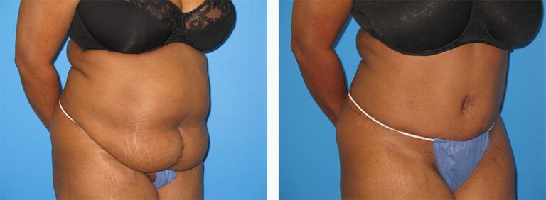 Abdominoplasty-Case-49-2