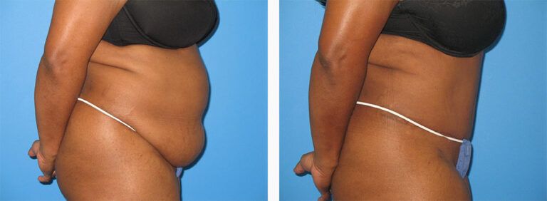 Abdominoplasty-Case-49-3