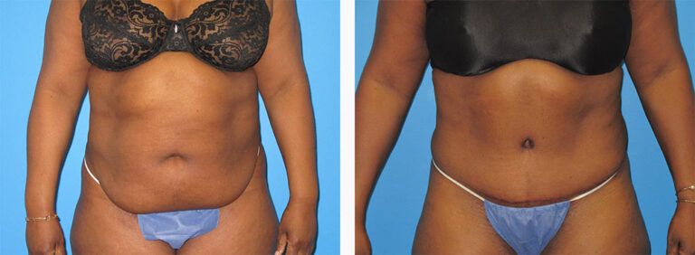 Abdominoplasty-Case-50-1