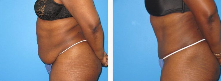 Abdominoplasty-Case-50-2