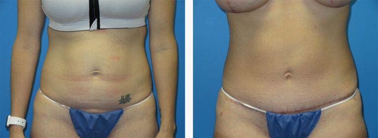 Abdominoplasty-Case-51-1