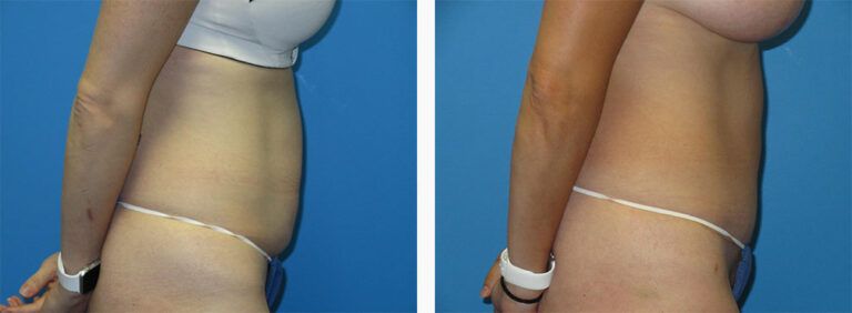 Abdominoplasty-Case-51-2