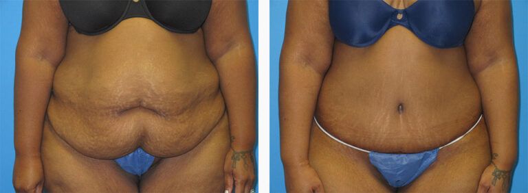 Abdominoplasty-Case-52-1