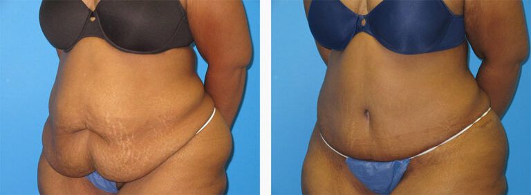 Abdominoplasty-Case-52-2