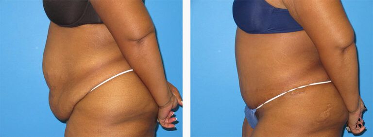 Abdominoplasty-Case-52-3