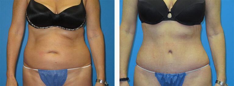 Abdominoplasty-Case-53-1
