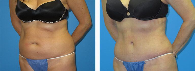 Abdominoplasty-Case-53-2