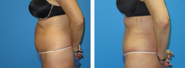 Abdominoplasty-Case-53-3