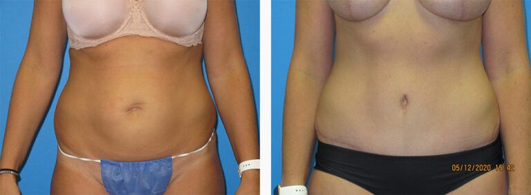 Abdominoplasty-Case-54-1