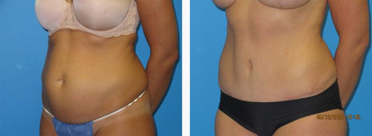 Abdominoplasty-Case-54-2