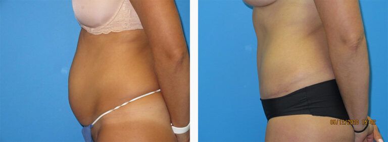 Abdominoplasty-Case-54-3