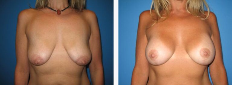 Breast-Lift-Case-1-1