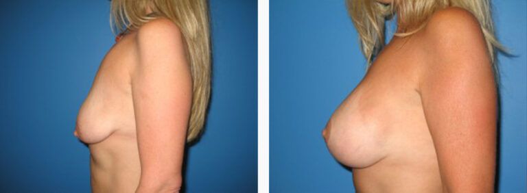 Breast-Lift-Case-1-2