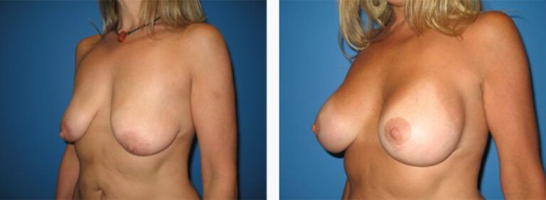 Breast-Lift-Case-1-3