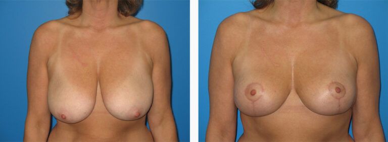 Breast-Lift-Case-10-1