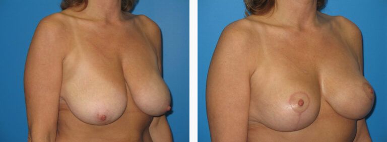 Breast-Lift-Case-10-2