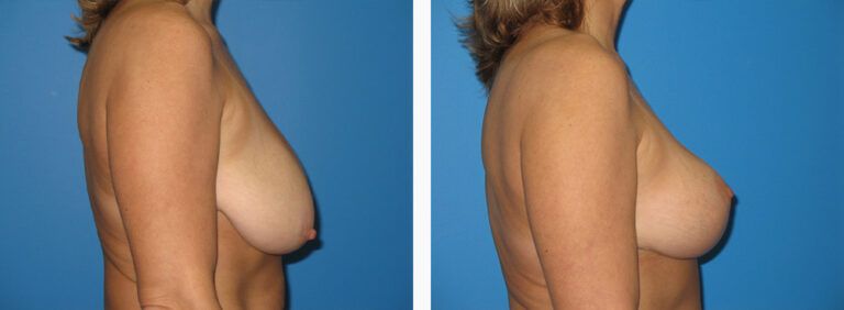 Breast-Lift-Case-10-3